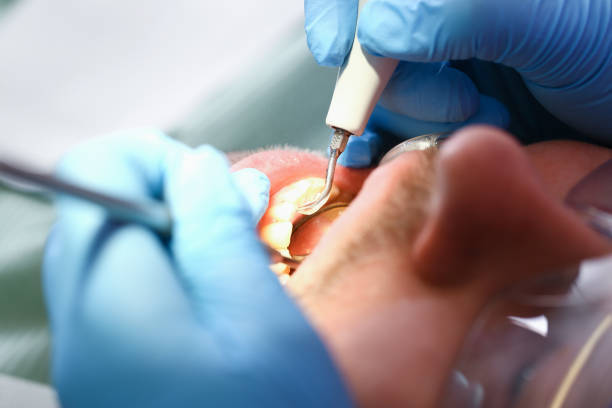 Best Emergency Care for Gum Disease in Cupertino, CA